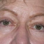 Blepharoplasty Before & After Patient #1434