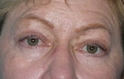 Blepharoplasty Before & After Patient #1434