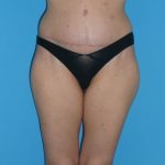 Tummy Tuck Before & After Patient #2135