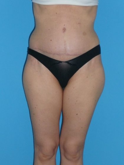 Tummy Tuck Before & After Patient #2135