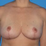 Breast Lift Before & After Patient #1829