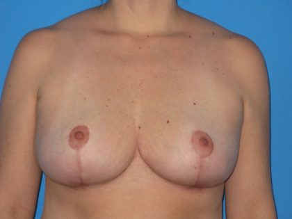 Breast Lift Before & After Patient #1829