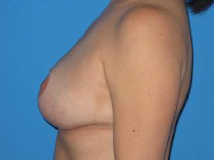 Breast Lift Before & After Patient #1829