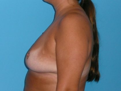 Breast Reduction Before & After Patient #1875