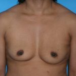 Breast Reconstruction Before & After Patient #1840