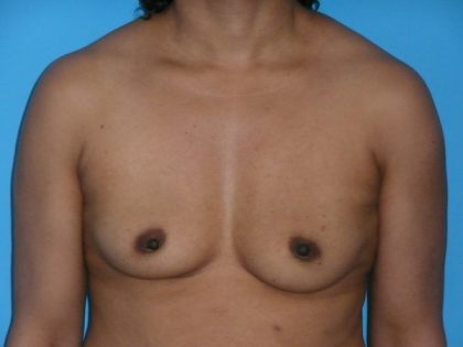 Breast Reconstruction Before & After Patient #1840