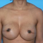 Breast Reconstruction Before & After Patient #1840