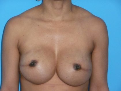 Breast Reconstruction Before & After Patient #1840