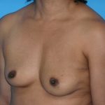 Breast Reconstruction Before & After Patient #1840