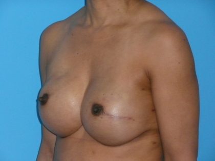 Breast Reconstruction Before & After Patient #1840