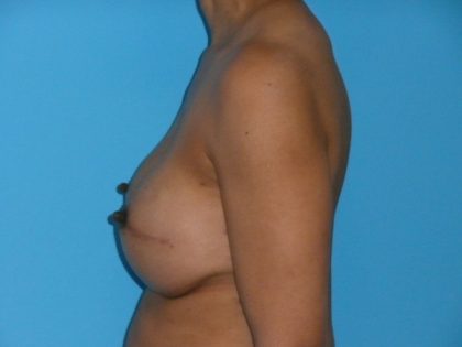 Breast Reconstruction Before & After Patient #1840