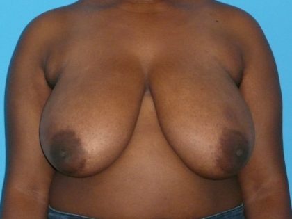 Breast Reduction Before & After Patient #1897