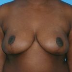 Breast Reduction Before & After Patient #1897