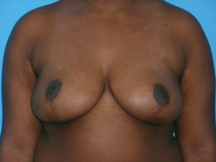 Breast Reduction Before & After Patient #1897