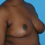 Breast Reduction Before & After Patient #1897