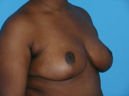 Breast Reduction Before & After Patient #1897