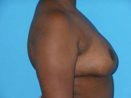Breast Reduction Before & After Patient #1897