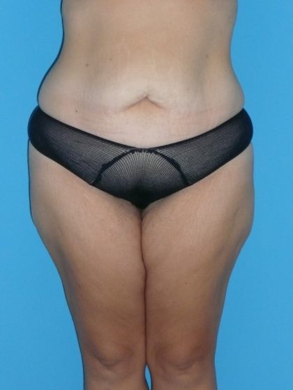 Tummy Tuck Before & After Patient #2142