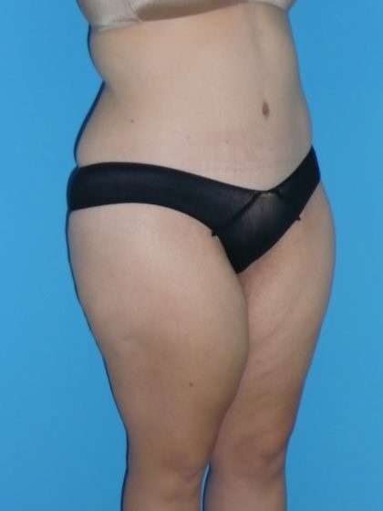 Tummy Tuck Before & After Patient #2142