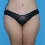 Tummy Tuck Before & After Patient #2142