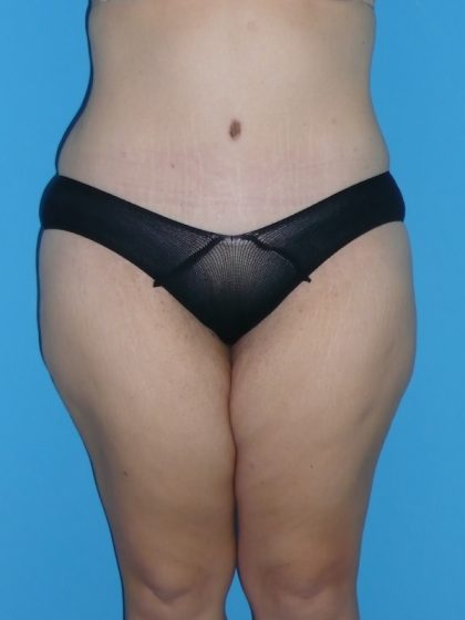 Tummy Tuck Before & After Patient #2142