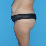 Tummy Tuck Before & After Patient #2142