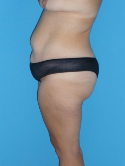 Tummy Tuck Before & After Patient #2142