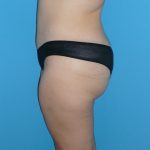 Tummy Tuck Before & After Patient #2142