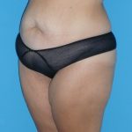 Tummy Tuck Before & After Patient #2142