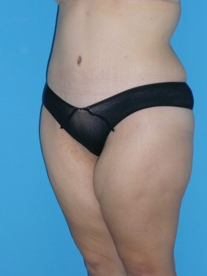 Tummy Tuck Before & After Patient #2142