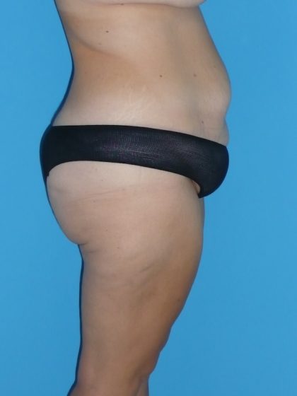 Tummy Tuck Before & After Patient #2142