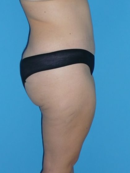 Tummy Tuck Before & After Patient #2142