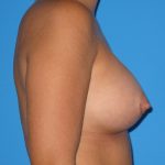 Breast Augmentation Before & After Patient #1580