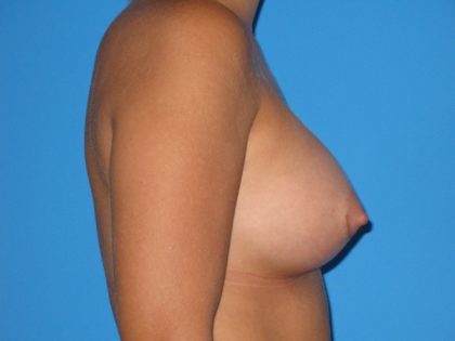 Breast Augmentation Before & After Patient #1580