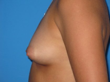 Breast Augmentation Before & After Patient #1580