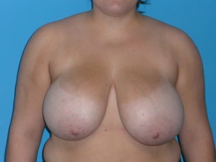 Breast Reduction Before & After Patient #1904