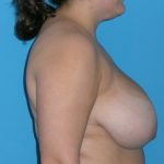 Breast Reduction Before & After Patient #1904