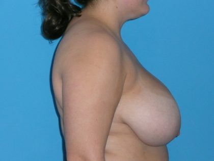 Breast Reduction Before & After Patient #1904