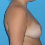 Breast Reduction Before & After Patient #1904