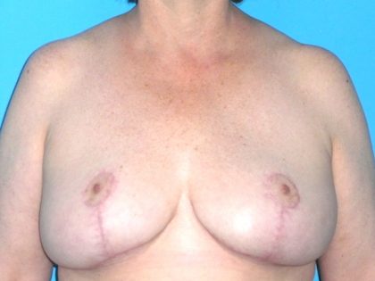Breast Reduction Before & After Patient #1915