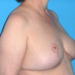 Breast Reduction Before & After Patient #1915