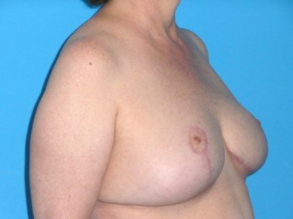 Breast Reduction Before & After Patient #1915