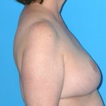 Breast Reduction Before & After Patient #1915