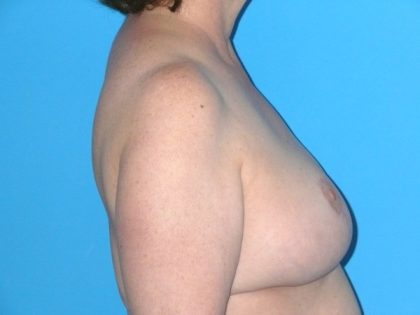 Breast Reduction Before & After Patient #1915