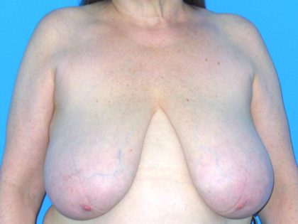 Breast Reduction Before & After Patient #1922
