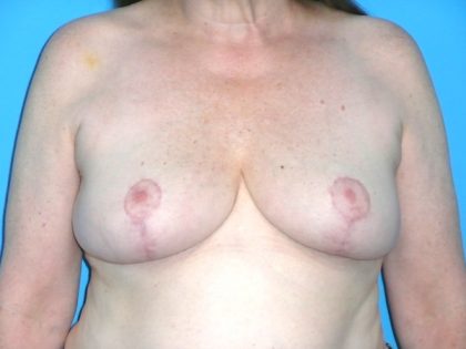 Breast Reduction Before & After Patient #1922