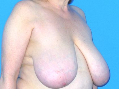 Breast Reduction Before & After Patient #1922