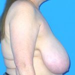 Breast Reduction Before & After Patient #1922