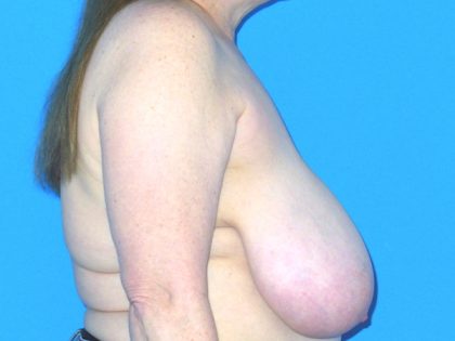 Breast Reduction Before & After Patient #1922