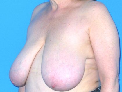 Breast Reduction Before & After Patient #1922